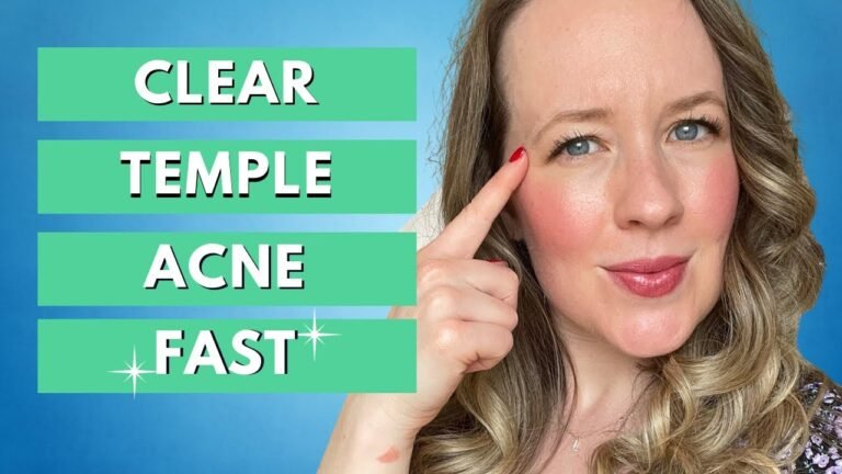Understanding the Best Treatment for Temple Acne